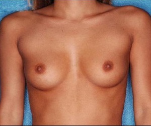 Breast augmentation Las Vegas
