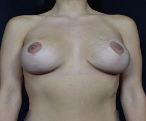 Breast Lift _after