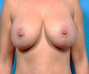 Breast augmentation VS breast lift_after