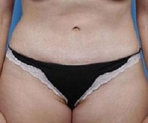 Las Vegas Tummy Tuck