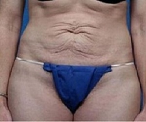 Tummy Tuck Las Vegas
