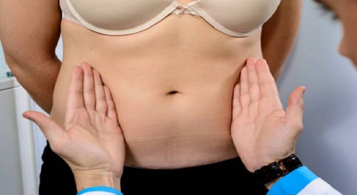 Tummy Tuck Facts from Dr. Stile