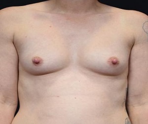 Breast Augmentation_before