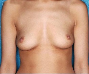Breast implants_before