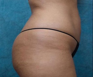 Brazilian Butt Lift Left