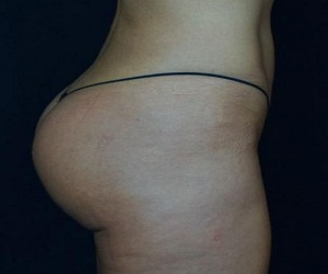 Brazilian Butt Lift Right