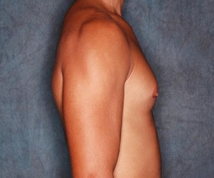 Gynecomastia Las Vegas