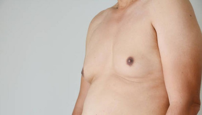 Gynecomastia Las Vegas