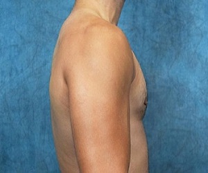 Las Vegas Gynecomastia