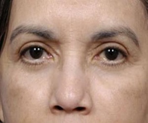 Blepharoplasty_after