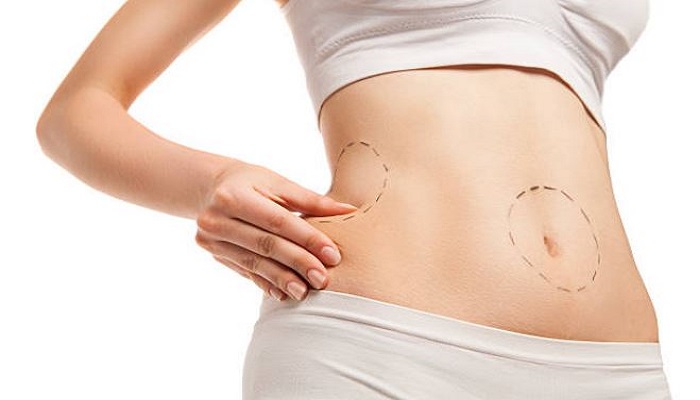 How Much Does Liposuction Cost?