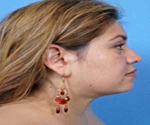 liposuction_after