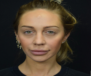 Botox Before