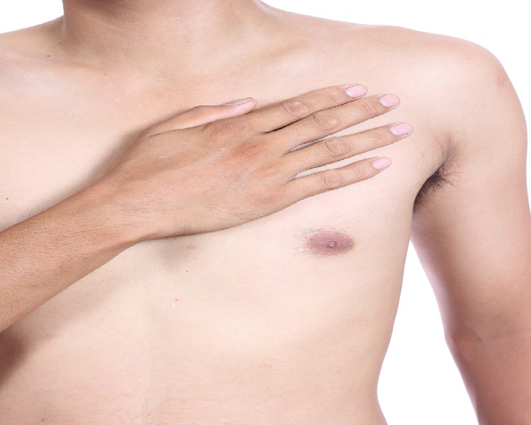 What is Gynecomastia?