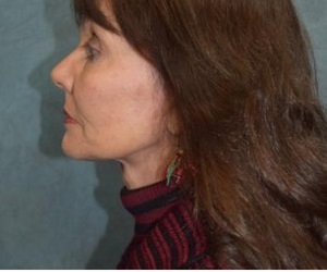 Neck Lift After Las Vegas