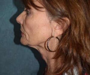 Neck Lift Before Las Vegas