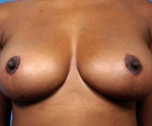 Breast reduction
