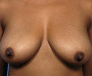 Breast Reduction