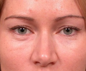 Before Las Vegas Eyelid Lift