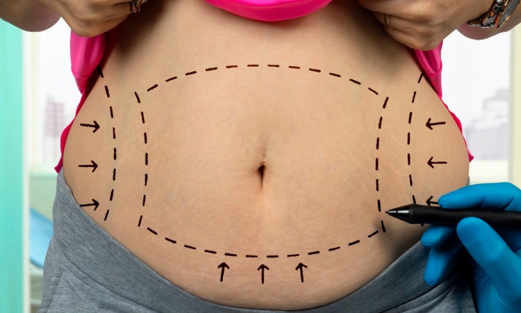 Am I a Candidate for a Tummy Tuck?