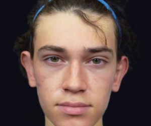 Otoplasty After Las Vegas