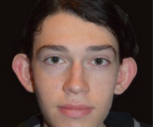 Otoplasty Before Las Vegas