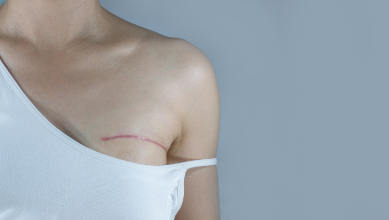 How Long Is Recovery From Breast Augmentation?