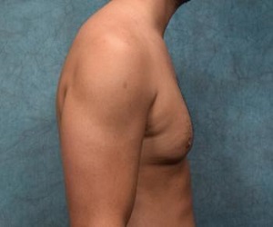 gyne_before