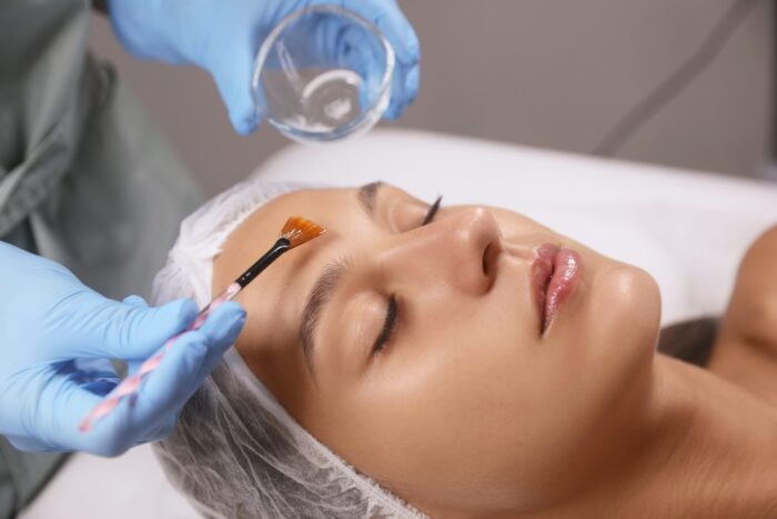 How Many Chemical Peels Are Needed to See Results?