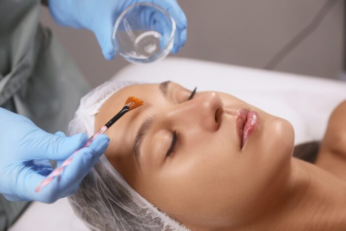 Chemical Peels Las Vegas