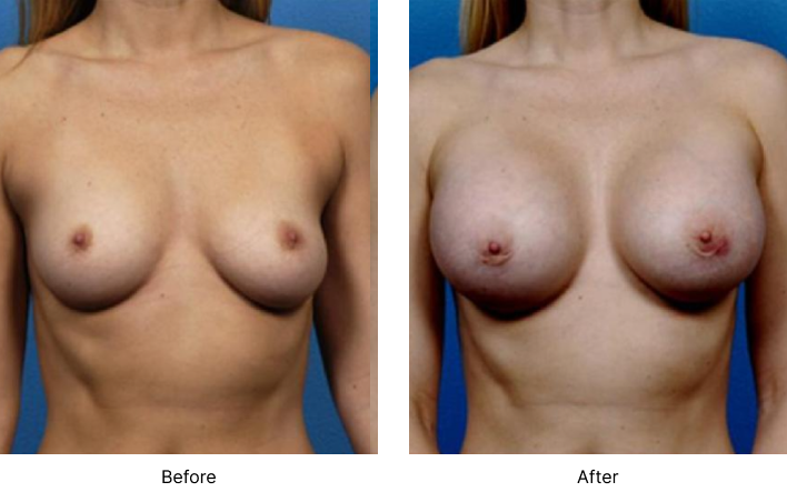 Breast Augmentation Before and After Las Vegas