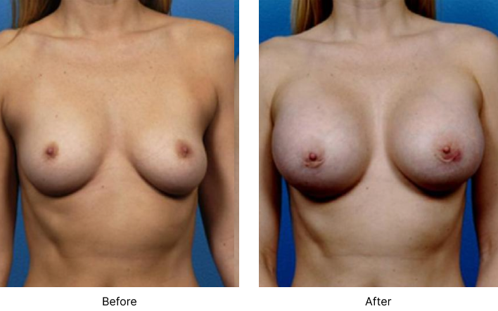 Breast Augmentation Before and After Las Vegas