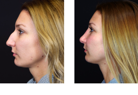 Rhinoplasty Before and After Las Vegas