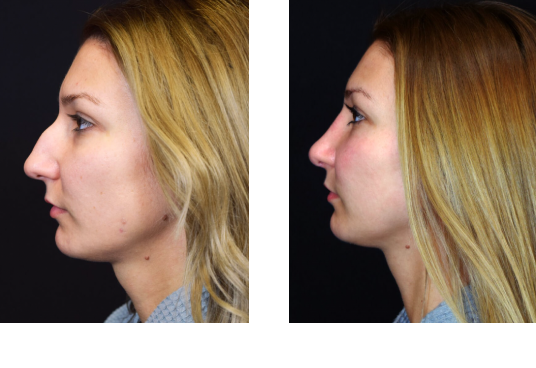 Rhinoplasty Before and After Las Vegas