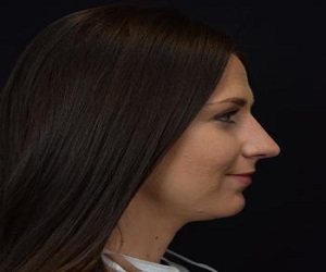 Rhinoplasty Before and After Las Vegas