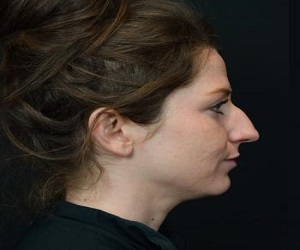 Rhinoplasty Before and After Las Vegas