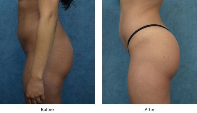 Brazilian Butt Lift Before and After Las Vegas