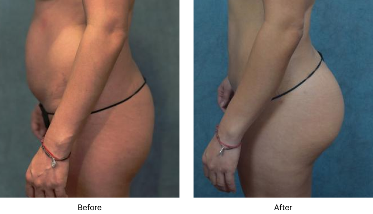 Brazilian Butt Lift Before and After Las Vegas