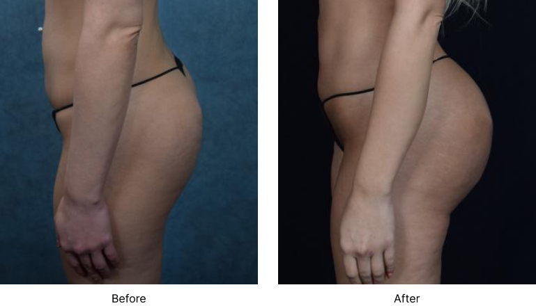 Brazilian Butt Lift Before and After Las Vegas