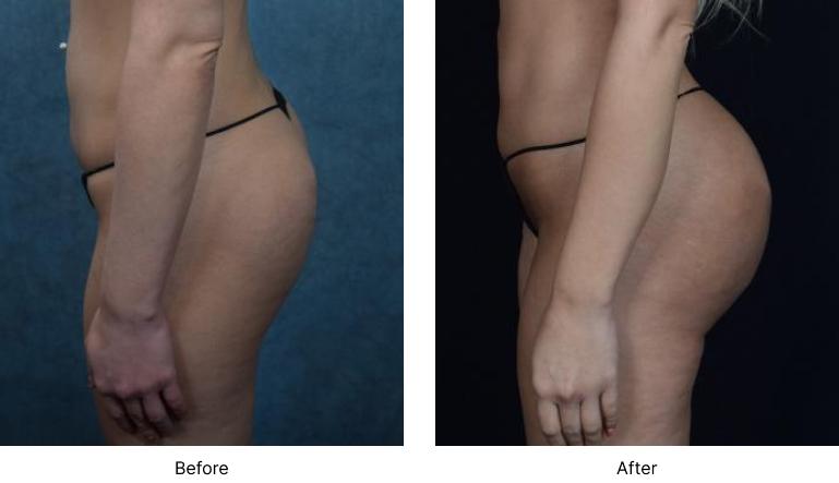 Brazilian Butt Lift Before and After Las Vegas