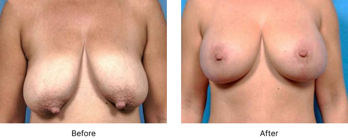 Breast Augmentation Before and After Las Vegas