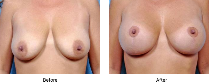 Breast Augmentation Before and After Las Vegas