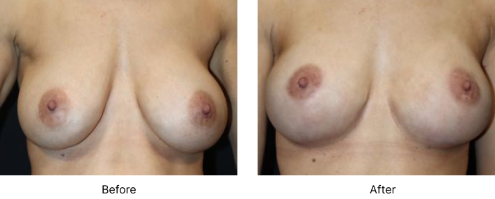 Breast Lift Before and After Las Vegas