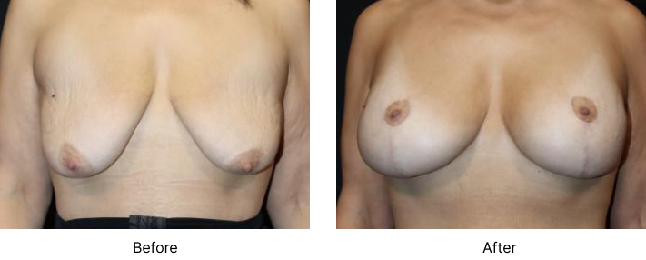 Breast Lift Before and After Las Vegas