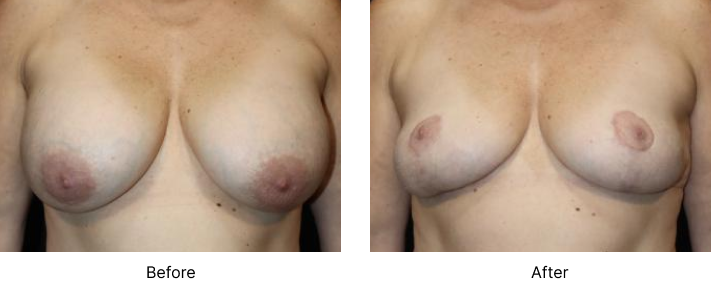 Breast Lift Before and After Las Vegas