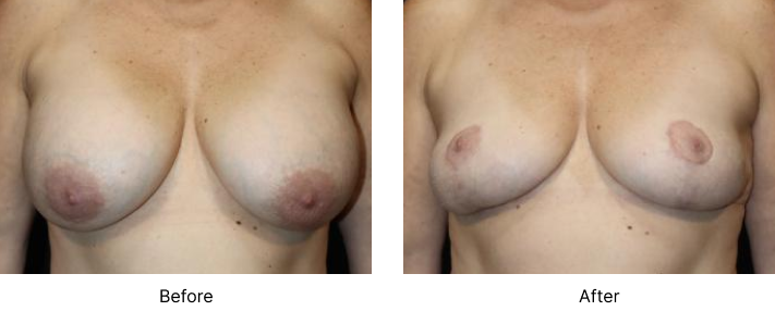 Breast Lift Before and After Las Vegas