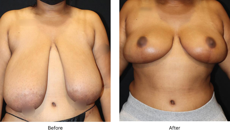 Breast Reduction Before and After Las Vegas