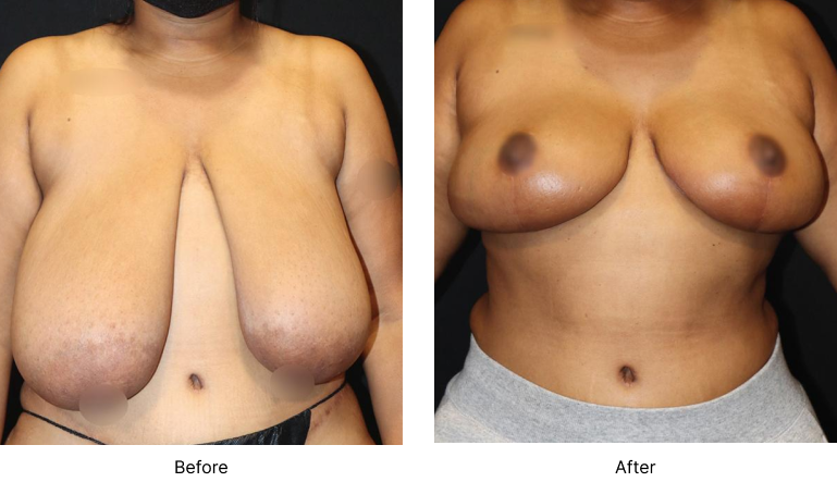 Breast Reduction Before and After Las Vegas