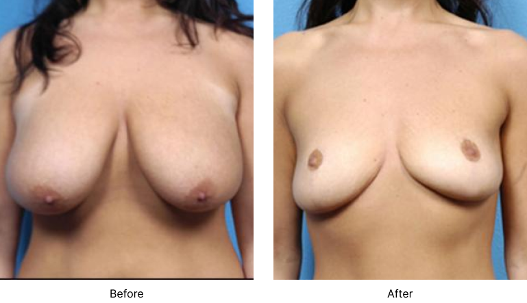 Breast Reduction Before and After Las Vegas