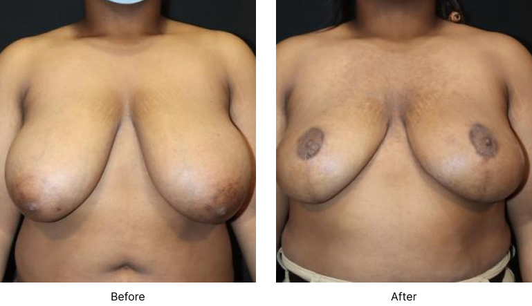 Breast Reduction Before and After Las Vegas